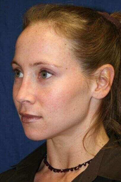 Rhinoplasty Before & After Patient #6132