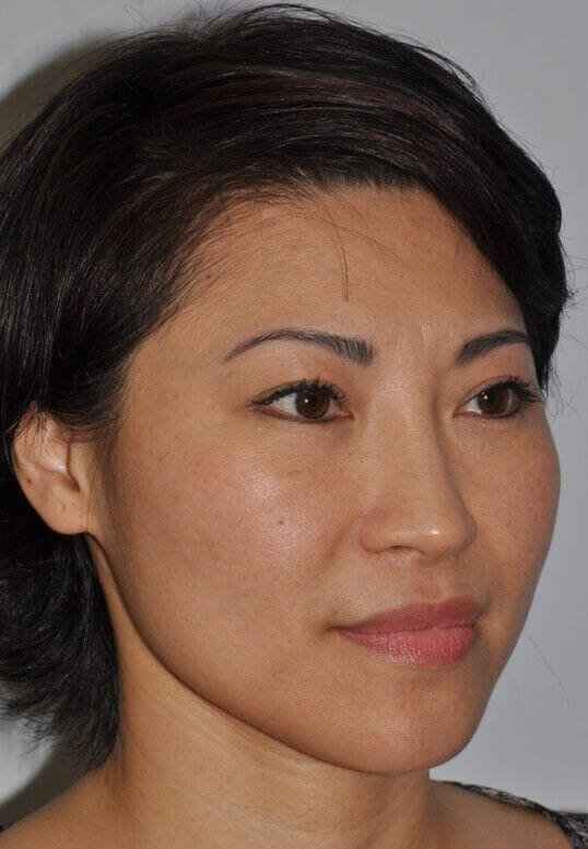Rhinoplasty Before & After Patient #6146