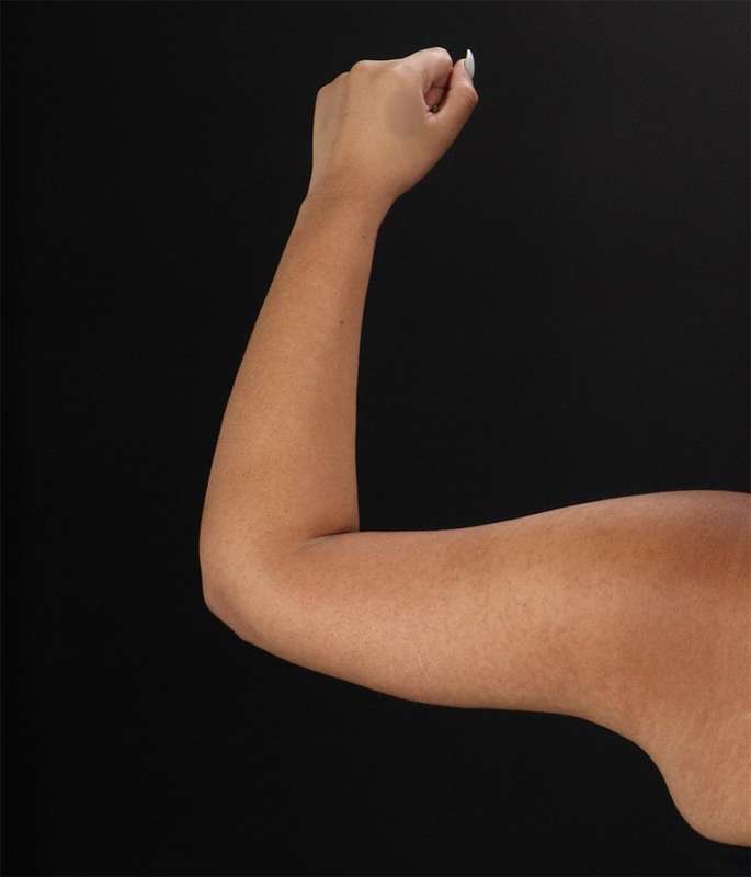 Brachioplasty (Arm Lift) Before & After Patient #1150