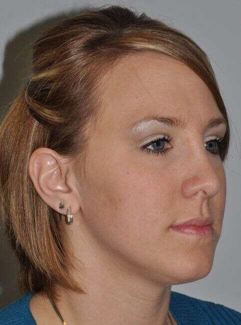 Rhinoplasty Before & After Patient #6153