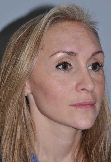 Rhinoplasty Before & After Patient #6160