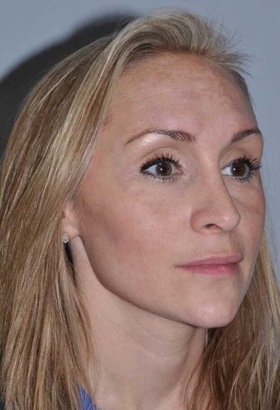 Rhinoplasty Before & After Patient #6160