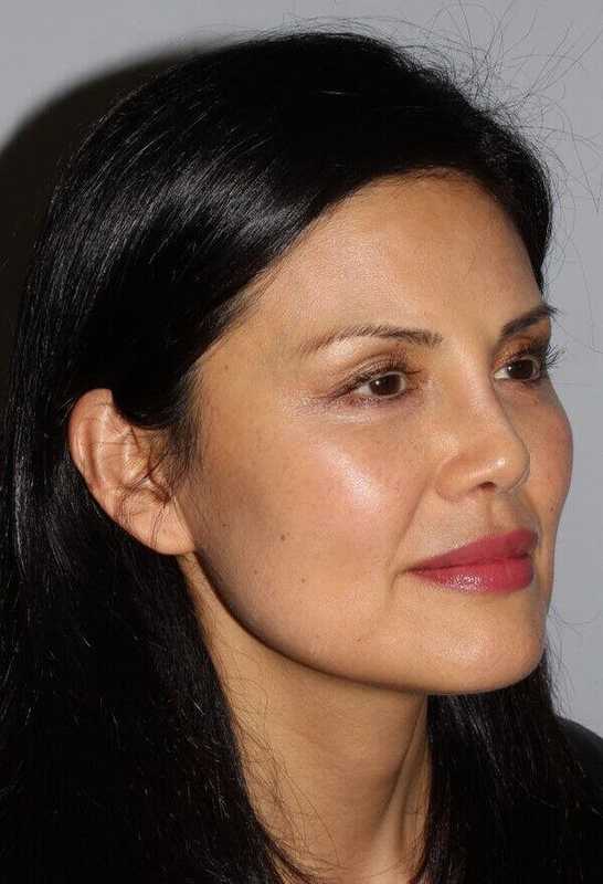 Rhinoplasty Before & After Patient #6167
