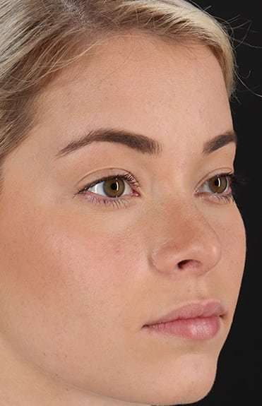 Rhinoplasty Before & After Patient #6178