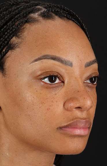 Rhinoplasty Before & After Patient #6189