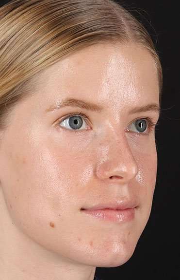 Rhinoplasty Before & After Patient #6200