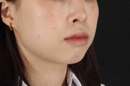 Lip Reduction Before & After Patient #6222