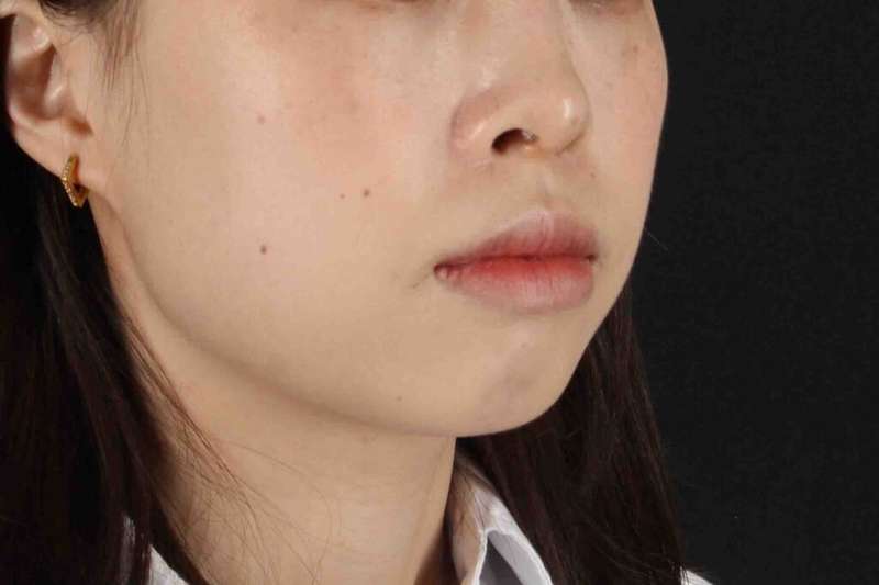 Lip Reduction Before & After Patient #6222