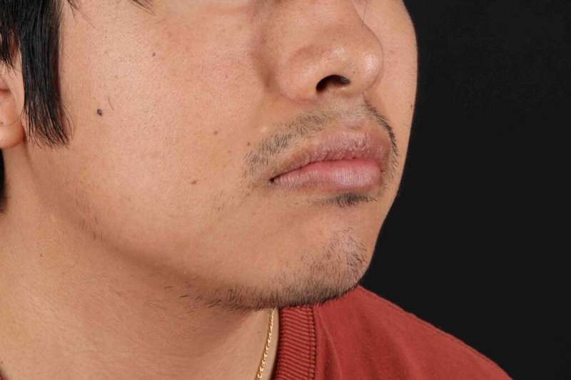 Lip Reduction Before & After Patient #6233