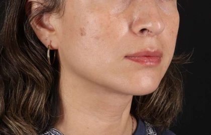 Lip Lift Before & After Patient #6244