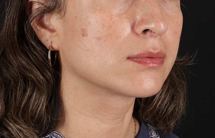 Lip Lift Before & After Patient #6244