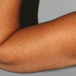 Brachioplasty (Arm Lift) Before & After Patient #1160