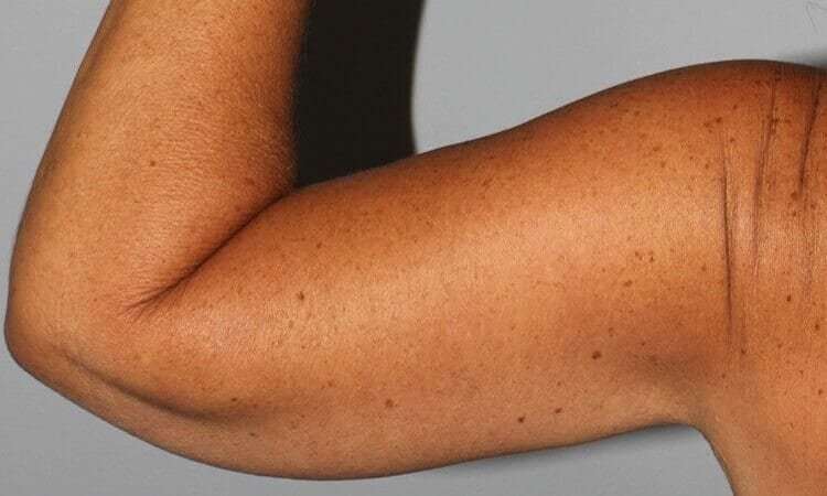 Brachioplasty (Arm Lift) Before & After Patient #1160