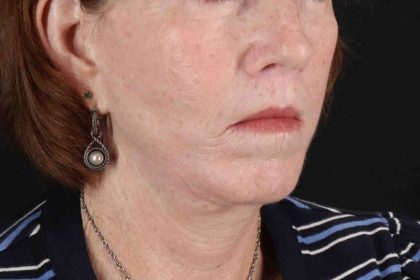 Lip Lift Before & After Patient #6255