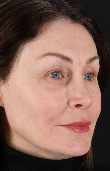 Lip Lift Before & After Patient #6266