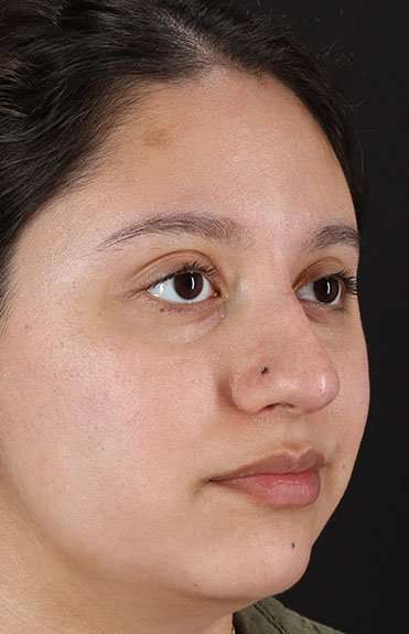 Liquid Rhinoplasty Before & After Patient #6299