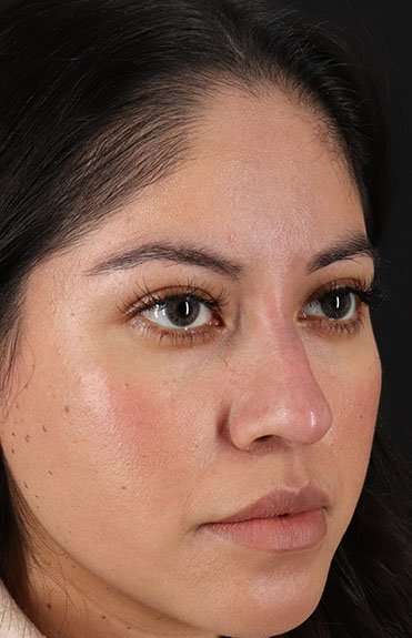 Liquid Rhinoplasty Before & After Patient #6319