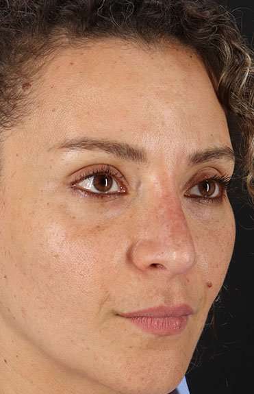 Liquid Rhinoplasty Before & After Patient #6333