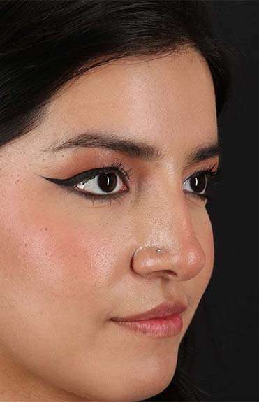 Liquid Rhinoplasty Before & After Patient #6344
