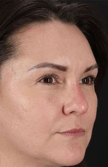 Liquid Rhinoplasty Before & After Patient #6366