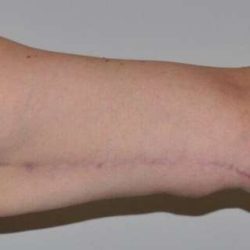 Brachioplasty (Arm Lift) Before & After Patient #1166