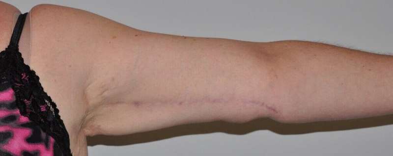 Brachioplasty (Arm Lift) Before & After Patient #1166