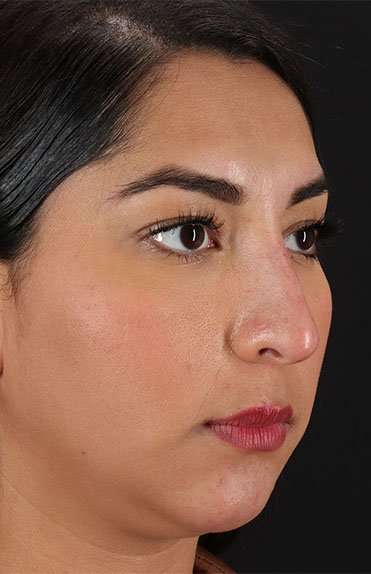 Liquid Rhinoplasty Before & After Patient #6377