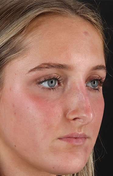 Liquid Rhinoplasty Before & After Patient #6388