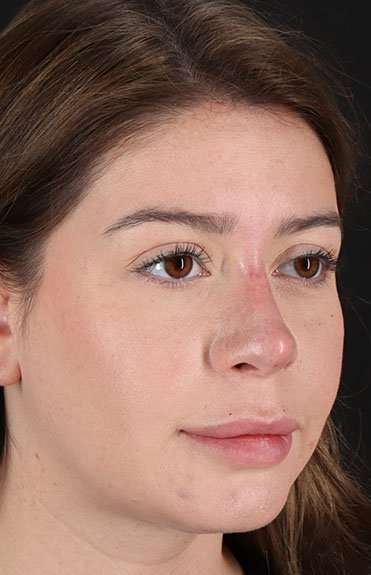 Liquid Rhinoplasty Before & After Patient #6399