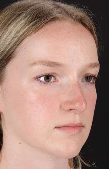 Liquid Rhinoplasty Before & After Patient #6425