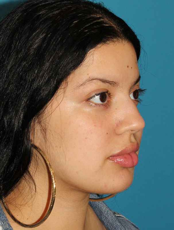 Buccal Fat Pad Before & After Patient #6436
