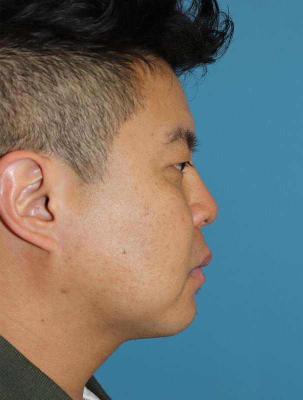 Buccal Fat Pad Before & After Patient #6441