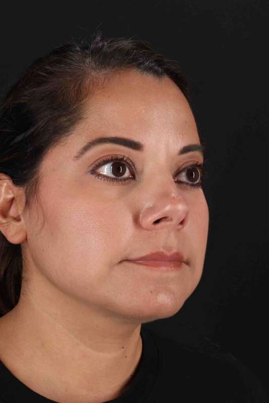 Buccal Fat Pad Before & After Patient #6485