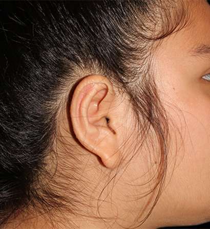 Otoplasty Before & After Patient #6501