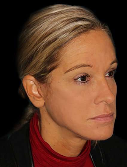 Neck Lift Before & After Patient #6517