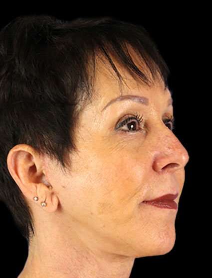 Neck Lift Before & After Patient #6528