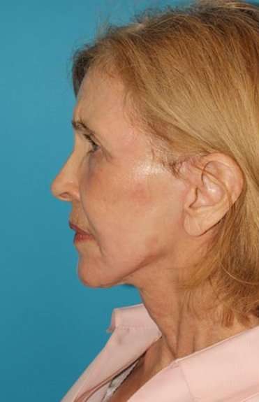Neck Lift Before & After Patient #6579
