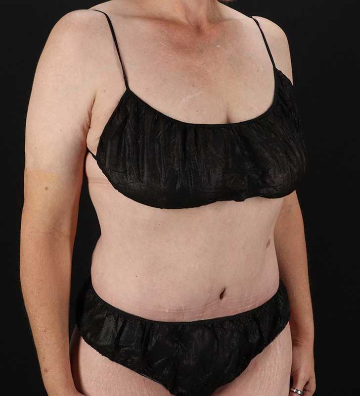 Cosmetic Body Lift Before & After Patient #1218