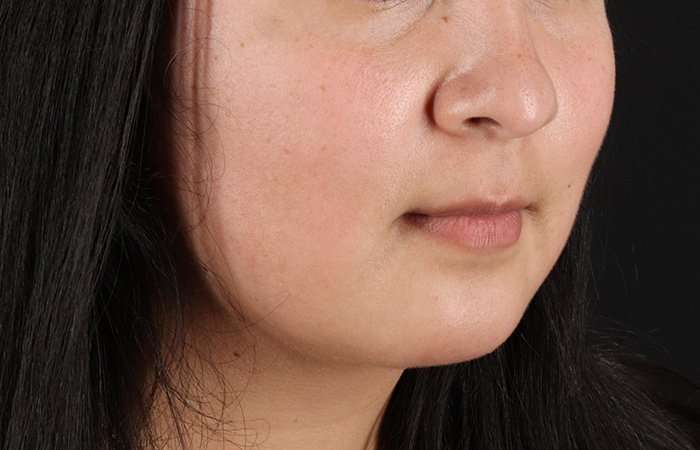 Neck Lift Before & After Patient #6743