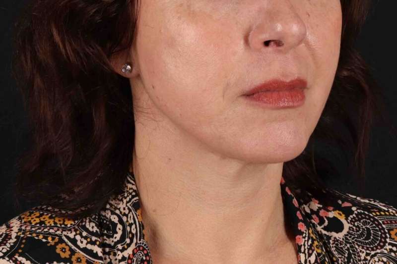 Neck Lift Before & After Patient #6797