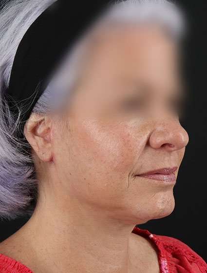 Neck Lift Before & After Patient #6878