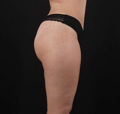 Liposuction Before & After Patient #1249