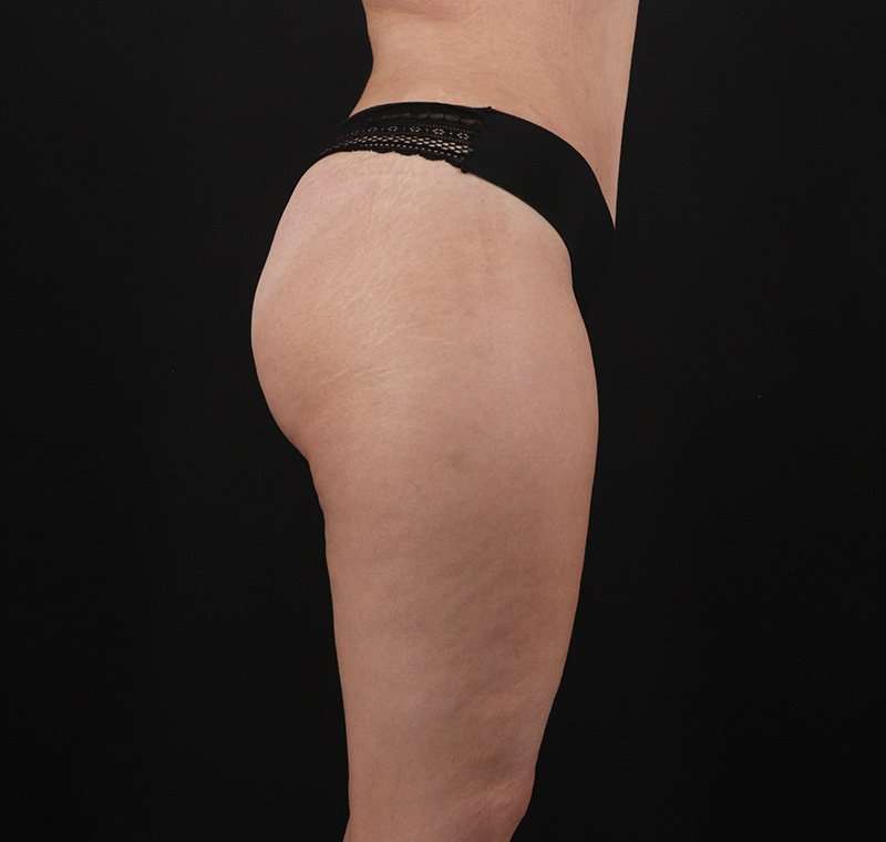 Liposuction Before & After Patient #1249
