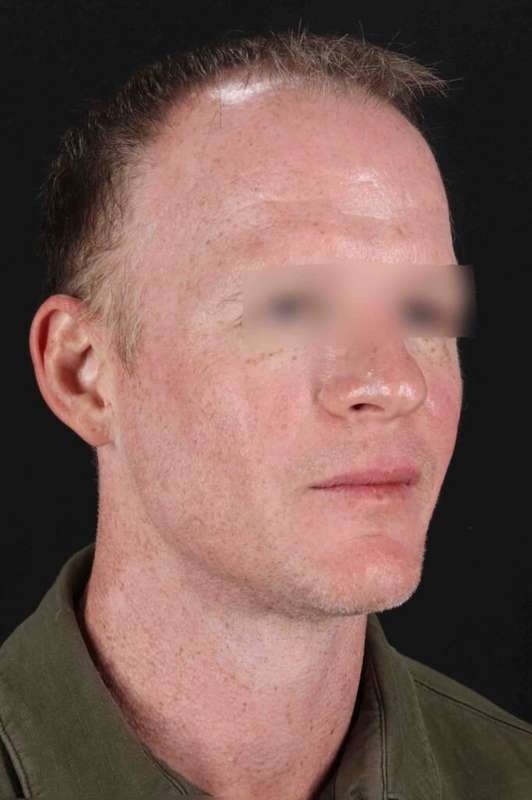 CO2 Laser Before & After Patient #6931