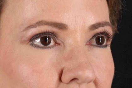 CO2 Laser Before & After Patient #6986