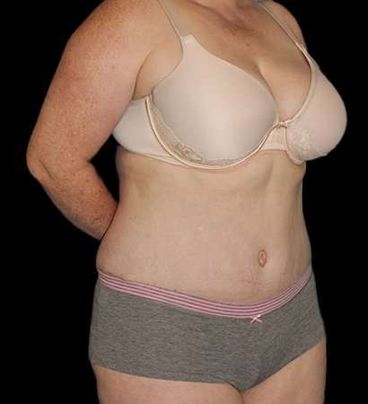 Abdominoplasty (Tummy Tuck) Before & After Patient #625