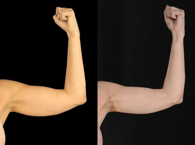 Liposuction Before & After Patient #1256