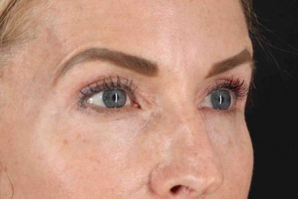 CO2 Laser Before & After Patient #7030