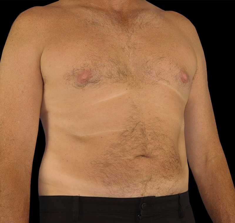 Liposuction Before & After Patient #1270