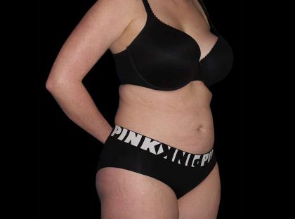 Liposuction Before & After Patient #1298
